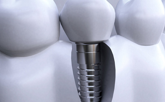 「公开排名」2023{南京}南京种植牙医院哪个更正规_种植牙术后能喝酒吗